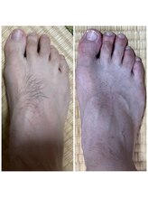 エヌ スタイル(N Style)/メンズ脱毛 