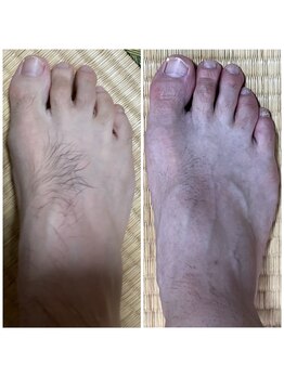 エヌ スタイル(N Style)/メンズ脱毛 