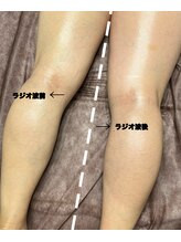 ステラ(Stella)/ラジオ波前/ラジオ波後