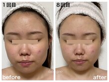 ダルセーニョ/エラも整い！小顔にも出会えた！