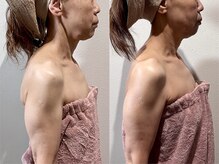 カルナ(CARNA)/猫背/姿勢改善にも/小顔コルギ