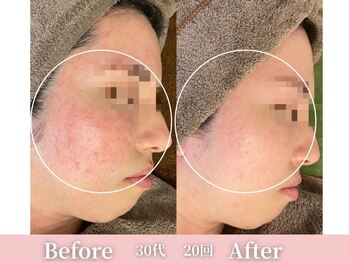 アメリイ 百合ヶ丘 新百合ヶ丘(Amerii)/ハーブピーリング/ニキビ/毛穴