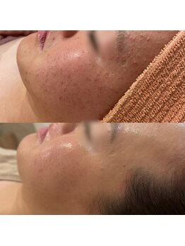 ジャストミービューティー(Just Me Beauty)/肌質改善/毛穴ケア/ニキビケア