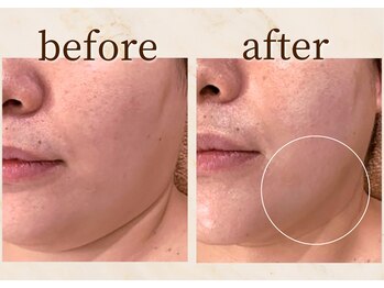 アンバー 恵比寿(AMBER)/ハーブピーリング+肌改善マシン