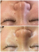 ロッシュ フェイス(Roche Face)/20代女性