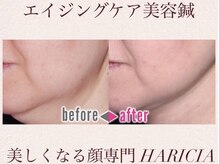 ハリシア(HARICIA)/劇的ビフォーアフター