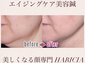 ハリシア(HARICIA)/劇的ビフォーアフター