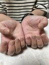 深爪でお悩みの方