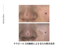 ビーマジック(美magic)/ララピール症例