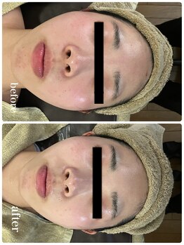 ジャスミン(Jasmin)/ダブルピール×イオン導入