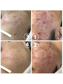 ラダ(RADA)/ハーブピーリング/シミ/ニキビ