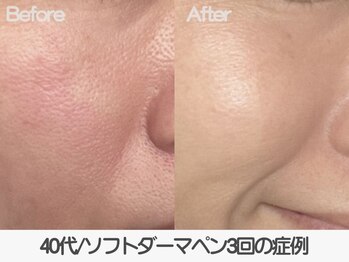 ラ コケット(La Coquette)/ファンデ塗ったら毛穴が落ちる