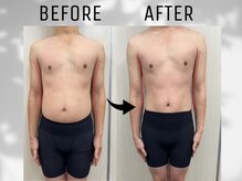 ネオン(Neon)/脂肪冷却12回