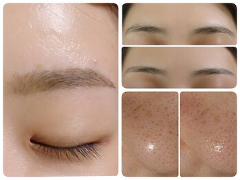 トータルビューティ ノイド(Noid)/いちご鼻撃退+美眉毛WAX脱毛