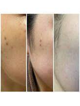 メイプルリーフ/シミケア