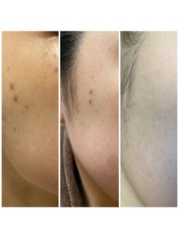 メイプルリーフ/シミケア