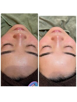 ジャドール ネイルアンドアイラッシュ(J'ADORE)/RVEIハーブピーリング