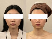 美容整体 レナトゥス 武庫之荘(Renatus)/眠れる骨格小顔矯正　1回施術