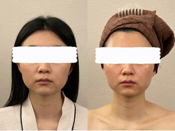 美容整体 レナトゥス 武庫之荘(Renatus)/眠れる骨格小顔矯正 1回施術