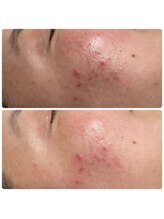 実夢(miyu)/プラズマ・ビフォーアフター