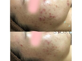 ストーリー 沼津店(STORY)/ハーブピーリング専門店STORY