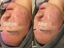 クレヴィア バイ サイバーエステ(CREBIA)/CHRISTINA【ハーブピーリング】