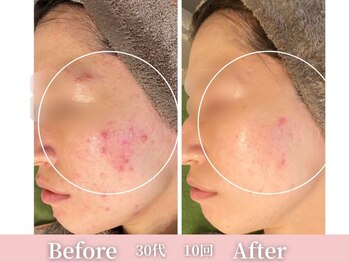 アメリイ 百合ヶ丘 新百合ヶ丘(Amerii)/ハーブピーリング/ニキビ/毛穴