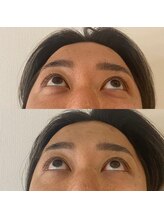 リアプア(Li'a)/目の下のふくらみがたった1回で