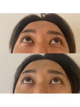 リアプア(Li'a)/目の下のふくらみがたった1回で