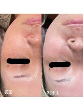 オリス(Oris)/グリーンピールbefore/after