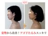 【 二重アゴ・もたつきが気になる方 】顎ライン集中小顔矯正￥26000→￥11980