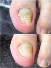 モアクリスタル(More Crystal)/爪形成