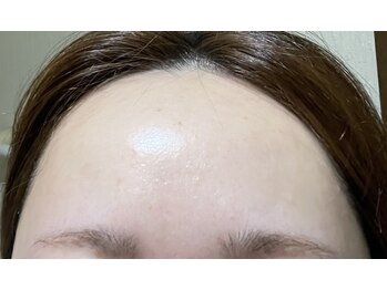 ララ オートクチュール(LALA HAUTOCOUTURE)/ニキビ/くすみ/ザラつき