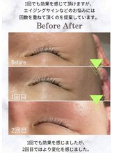 サロンド エステ ミニョン(salon de esthe mignon)/ラミピール！世界発！縦横ジワ