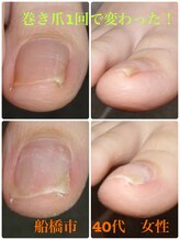 巻き爪じゅん 船橋店/巻き爪が1回で変わった！