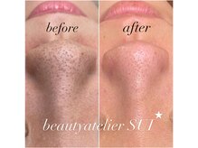 黒ずみ・いちご鼻・毛穴の開きはお任せください！