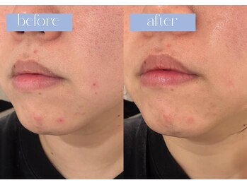 ステラ(STELLA)/気になる赤みもケアできる!