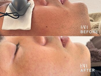 ファン(FAN)/【メンズひげ脱毛】BEFORE-AFTER
