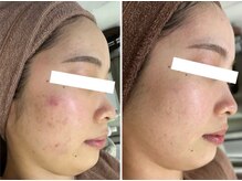 ホワイトアクア 四日市店(WHITE AQUA)/ニキビケア/ニキビ改善/美肌