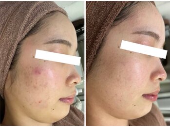 ホワイトアクア 四日市店(WHITE AQUA)/ニキビケア/ニキビ改善/美肌