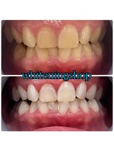 ホワイトニングショップ 日進店/Before After日進ホワイトニング