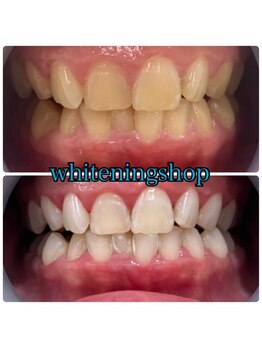 ホワイトニングショップ 日進店/Before After日進ホワイトニング