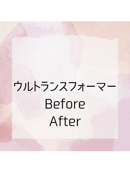 ヴィトワ(Vitowa)/ウルトランスフォーマー施術例