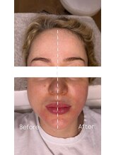 メザメ(MEZAME)/バッカルマッサージ