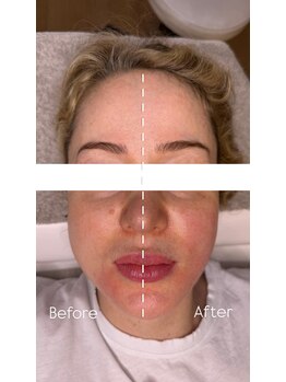 メザメ(MEZAME)/バッカルマッサージ