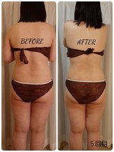 レーヌ青山(Reine Aoyama)/インディバで冷え改善！腸活温活