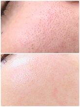 アンジェロ/【ニキビケア】肌育プログラム