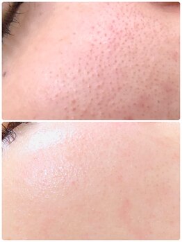 アンジェロ/【ニキビケア】肌育プログラム