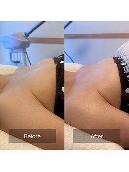 天使の艶肌 武蔵小杉店/バストアップ before/after1