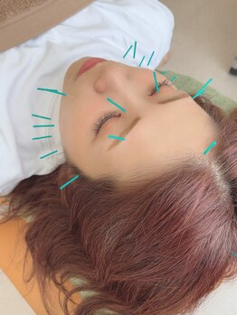 ヒーリングサロン アージュ(A-je)/★美顔鍼＋小顔矯正★